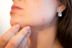 Molecules Pimple Patches